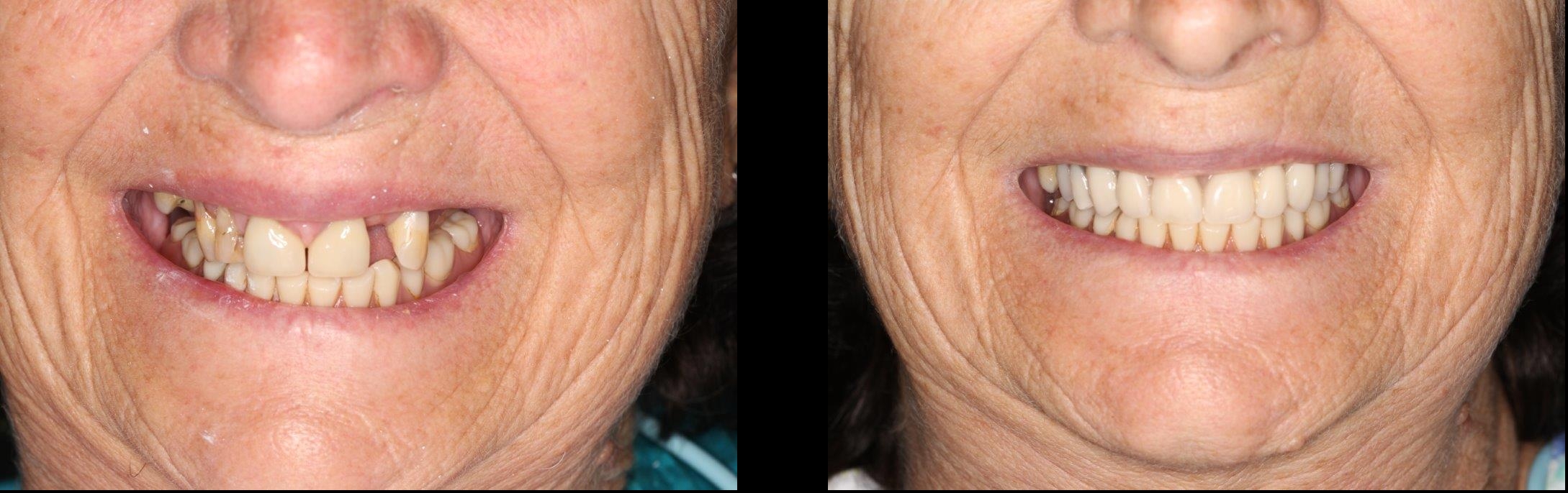 all on 4 dental implants